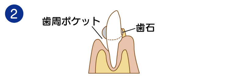 歯周病02